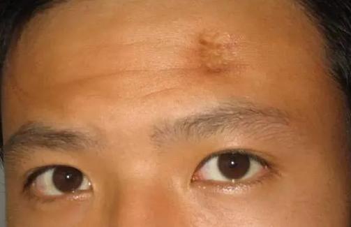 额头有疤痕的面相，额头上的疤痕是如何形成的？
